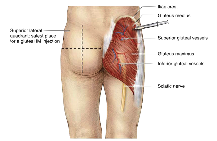 How-To-Inject-glutes