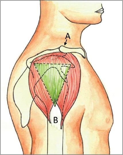 how-to-perform-deltoid-injection-site-testosterone